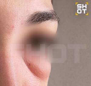 Брянская женщина стала жертвой препарата для удаления мешков под глазами