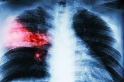 В Брянской области снизилась заболеваемость туберкулёзом