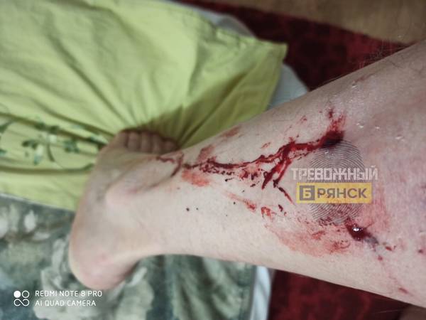 В Брянске голодные псы разорвали ногу мужчине возле кафе 