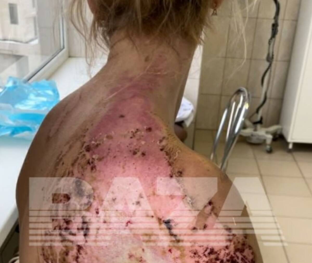 В НИИ Склифосовского на операционном столе загорелась пациентка