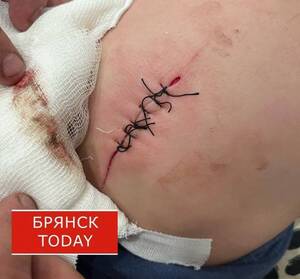 СК возбудил уголовное дело после публикации о травме мальчика в Брянске