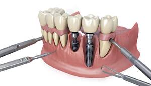 Скуловая имплантация зубов: особенности и преимущества